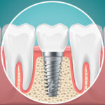 Stomatology illustrations. Dental implants and healthy teeth