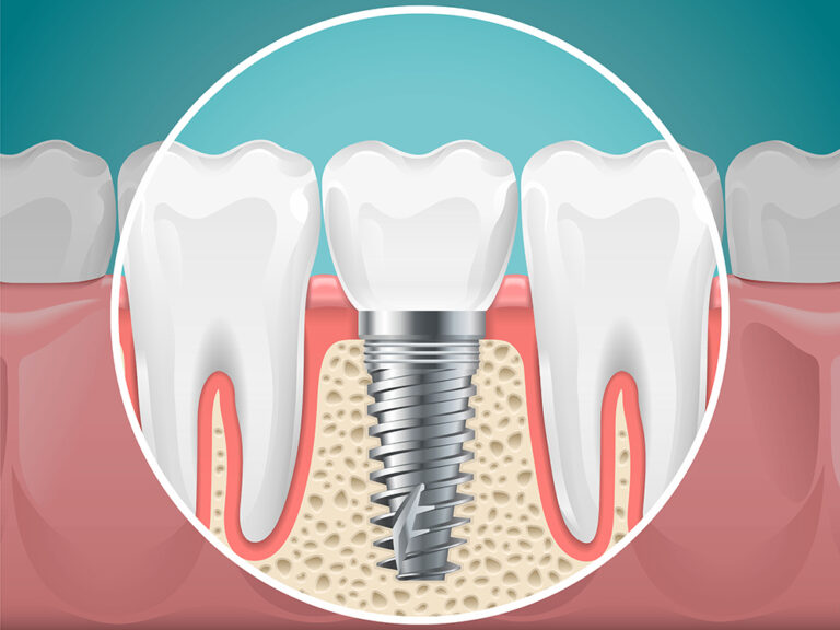 Stomatology illustrations. Dental implants and healthy teeth