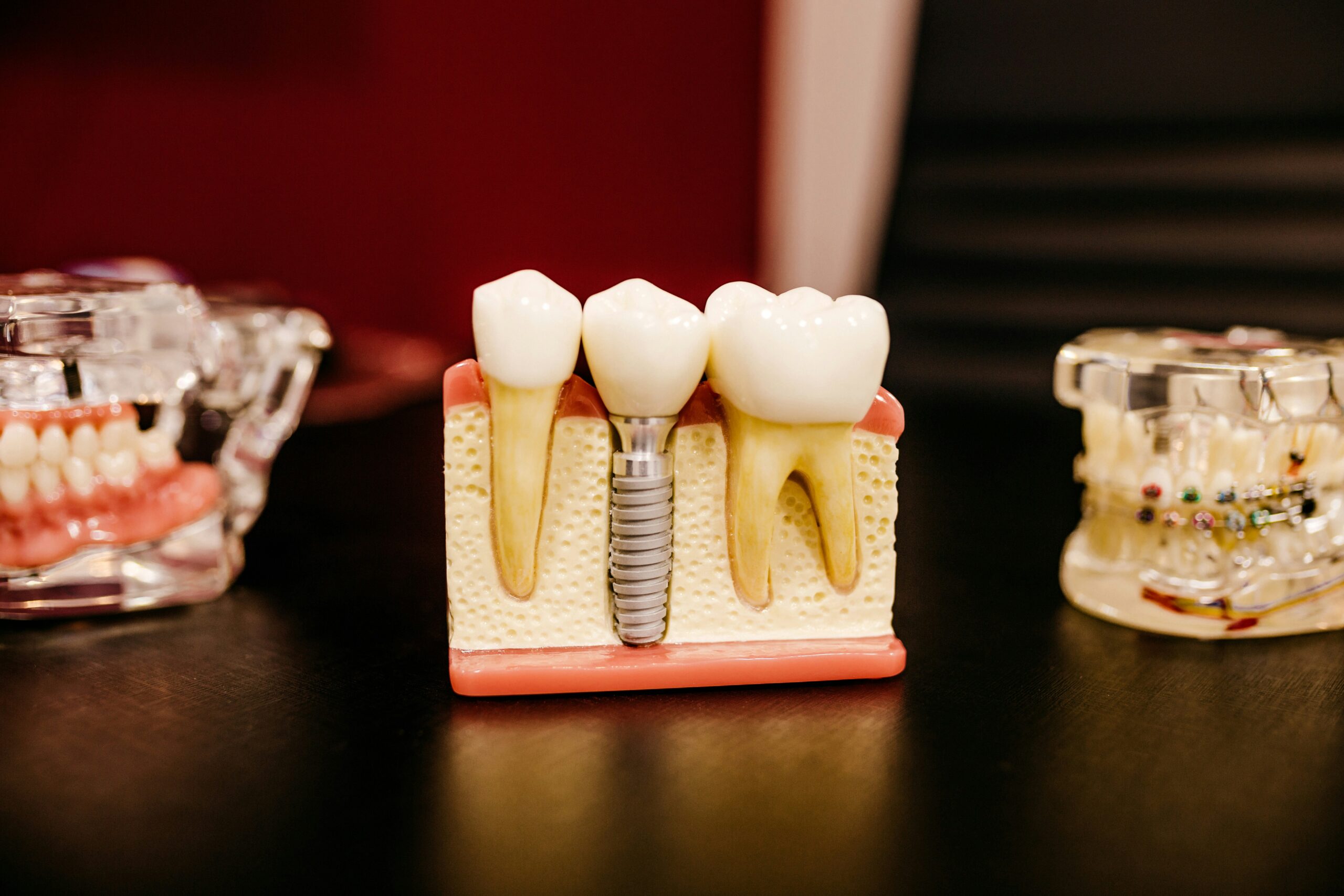 Implanturile dentare: Când sunt necesare și ce implică