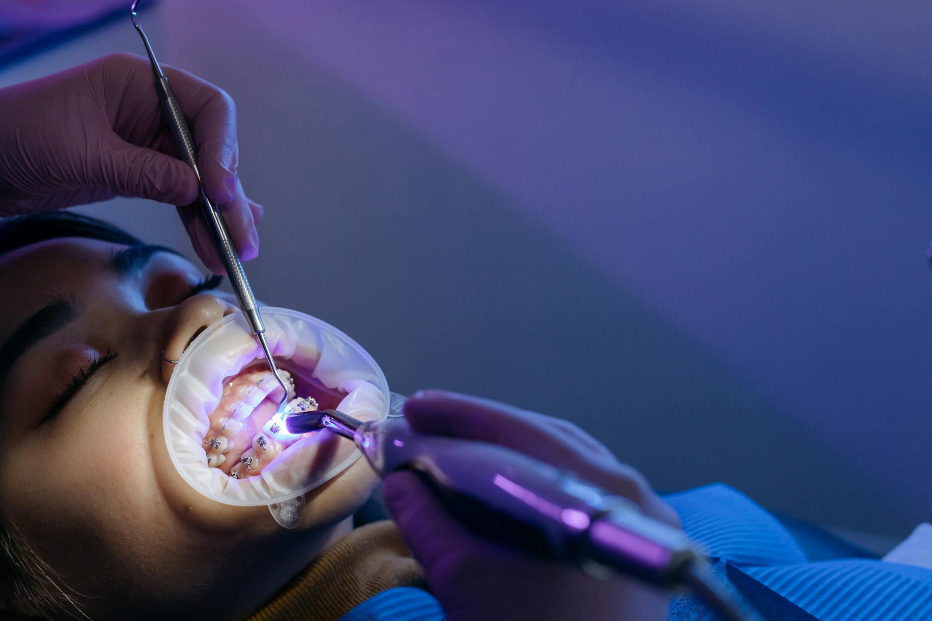 Aparatul dentar ceramic: frumos, dar eficient?